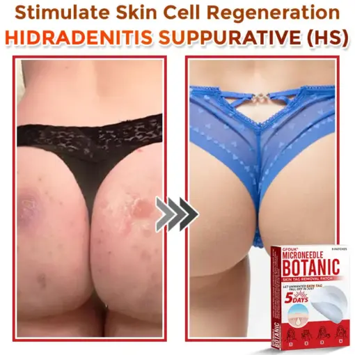 GFOUK® MicroNeedle Botanic Skin Tag Removal Patch