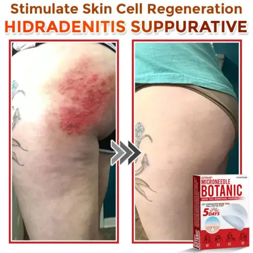 GFOUK® MicroNeedle Botanic Skin Tag Removal Patch