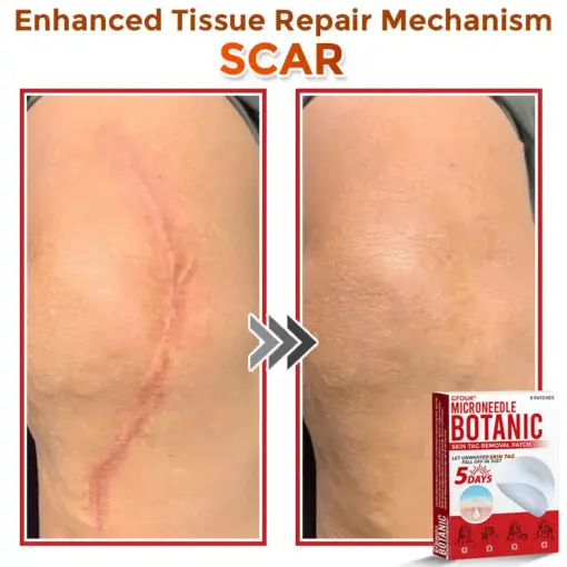 GFOUK® MicroNeedle Botanic Skin Tag Removal Patch