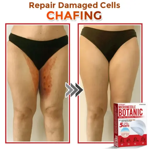GFOUK® MicroNeedle Botanic Skin Tag Removal Patch
