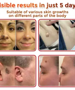 GFOUK® MicroNeedle Botanic Skin Tag Removal Patch