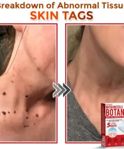 GFOUK® MicroNeedle Botanic Skin Tag Removal Patch