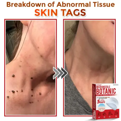 GFOUK® MicroNeedle Botanic Skin Tag Removal Patch