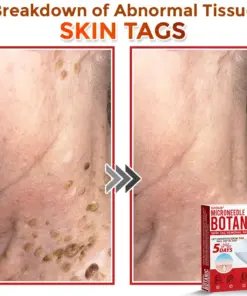 GFOUK® MicroNeedle Botanic Skin Tag Removal Patch