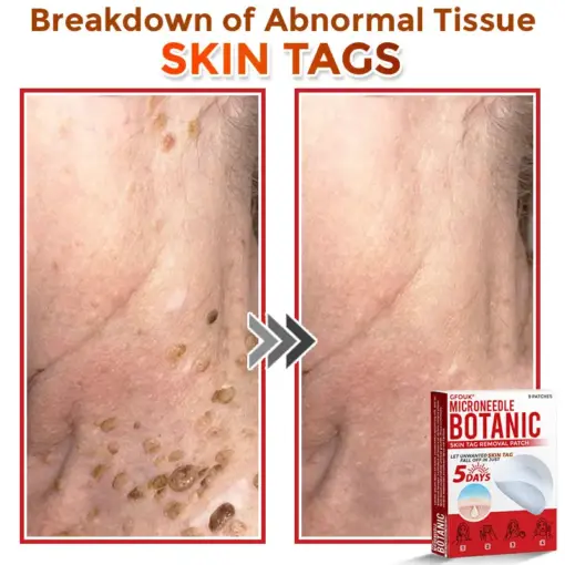 GFOUK® MicroNeedle Botanic Skin Tag Removal Patch