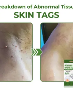 GFOUK® Magnesium MicroNeedle Quick Remove Skin Tag Patches