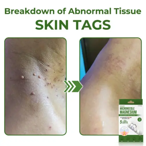 GFOUK® Magnesium MicroNeedle Quick Remove Skin Tag Patches