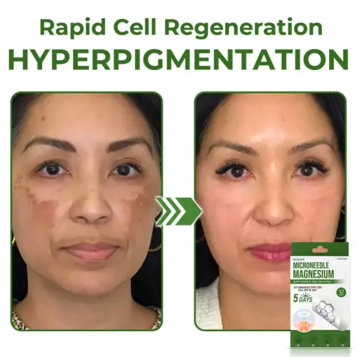 GFOUK® Magnesium MicroNeedle Quick Remove Skin Tag Patches