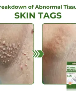 GFOUK® Magnesium MicroNeedle Quick Remove Skin Tag Patches