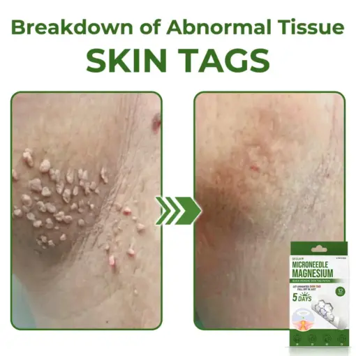 GFOUK® Magnesium MicroNeedle Quick Remove Skin Tag Patches
