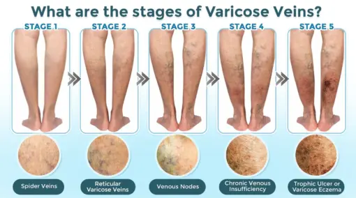 GFOUK® VenaRestore MicroNeedle Vein Repair Patch