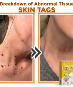 GFOUK® Bee Venom MicroNeedle Botanic Skin Tag Removal Patch