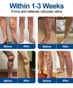 𝐆𝐅𝐎𝐔𝐊® 𝐕𝐞𝐢𝐧𝐓𝐚𝐫𝐠𝐞𝐭 𝐌𝐢𝐜𝐫𝐨𝐧𝐞𝐞𝐝𝐥𝐞 𝐏𝐚𝐭𝐜𝐡