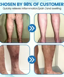 GFOUK® VascuCare Vein Healing Spray