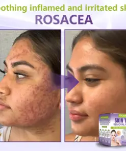 GFOUK® Soluble Microneedle Botanical Skin Tag Removal Patch