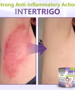 GFOUK® Soluble Microneedle Botanical Skin Tag Removal Patch