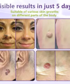 GFOUK® Soluble Microneedle Botanical Skin Tag Removal Patch