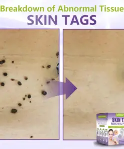 GFOUK® Soluble Microneedle Botanical Skin Tag Removal Patch