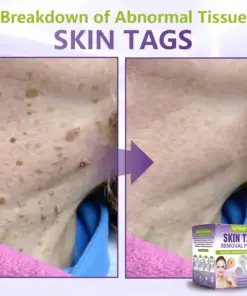 GFOUK® Soluble Microneedle Botanical Skin Tag Removal Patch