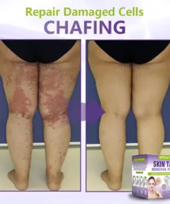 GFOUK® Soluble Microneedle Botanical Skin Tag Removal Patch