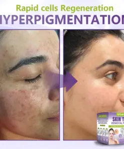 GFOUK® Soluble Microneedle Botanical Skin Tag Removal Patch