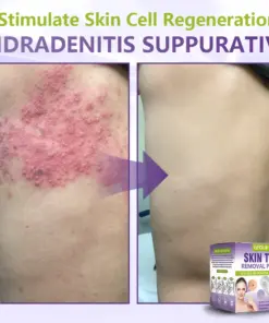 GFOUK® Soluble Microneedle Botanical Skin Tag Removal Patch