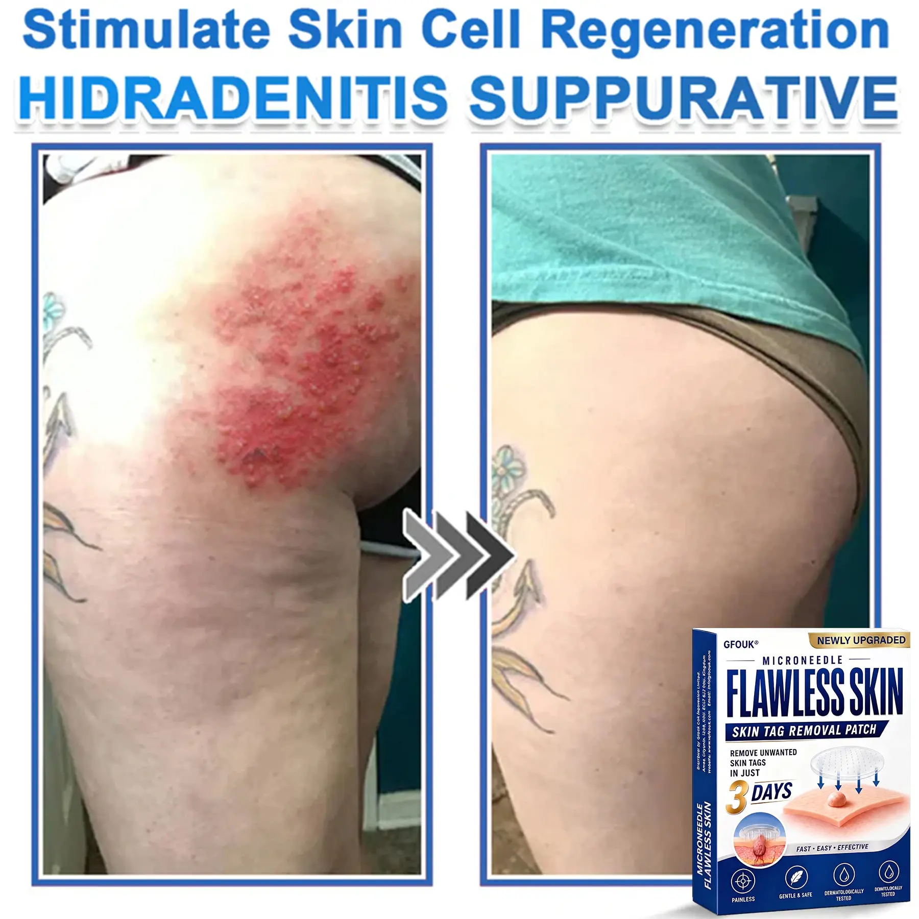 GFOUK® 2026 Newly Upgraded 2-in-1 Microneedle Hydrocolloid Patches