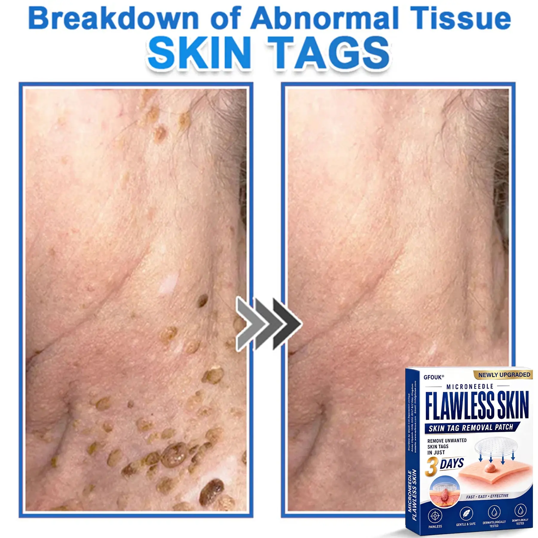 GFOUK® 2026 Newly Upgraded 2-in-1 Microneedle Hydrocolloid Patches
