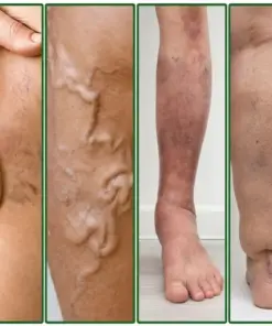 GFOUK® 7-in-1 Microneedle Vein & Lipedema Treatment Patch
