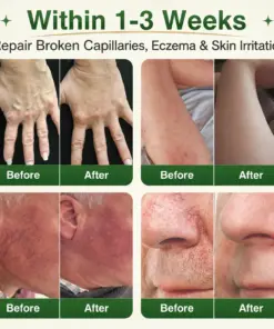 GFOUK® 7-in-1 Microneedle Vein & Lipedema Treatment Patch