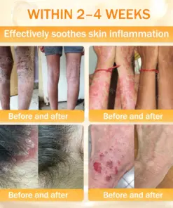 GFOUK® Bee Venom Skin Renewal Cream