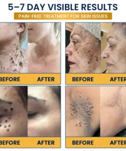 GFOUK® 7-Day MicroNeedle Wart & Skin Tag Removal Patch