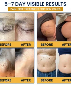 GFOUK® 7-Day MicroNeedle Wart & Skin Tag Removal Patch