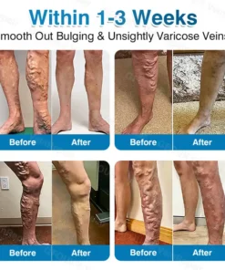 GFOUK® VeinRepair Microneedle Patch Roll